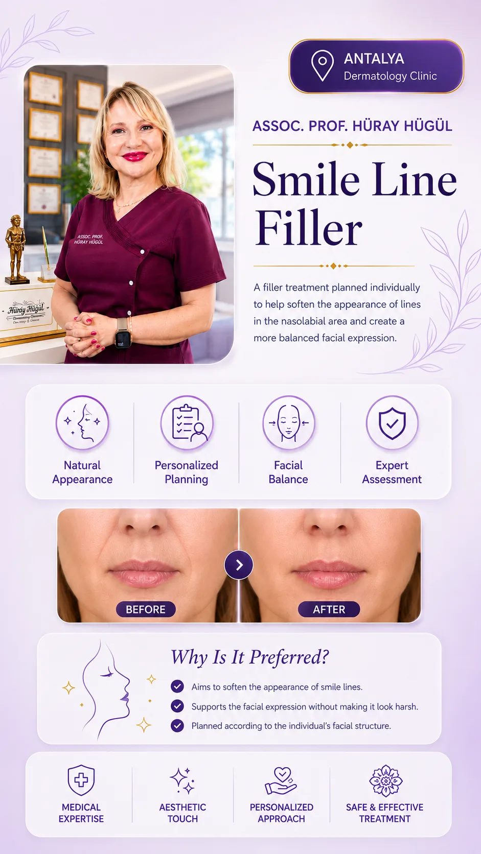 What Is Smile Line Filling? How Are Nasolabial Folds Softened? | Doç. Dr. Hüray Hügül