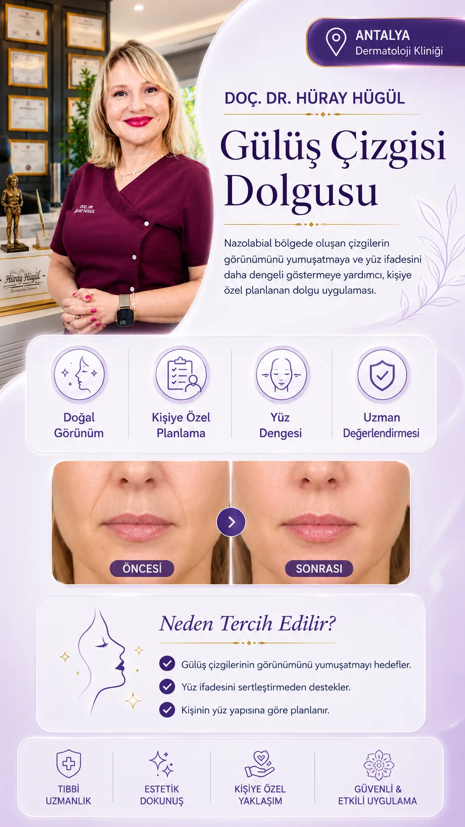 Gülüş Çizgisi Dolgusu Nedir? Nazolabial Çizgiler Nasıl Yumuşatılır?