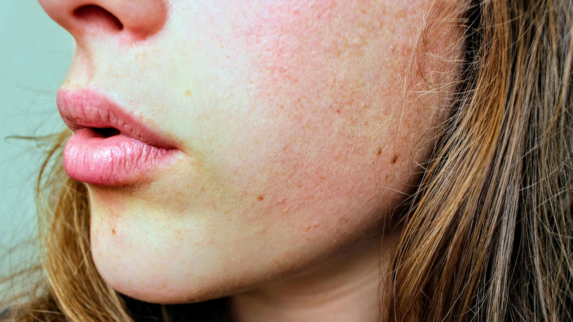 Application Soins contre l'acné — Pr. ass. Hüray Hügül
