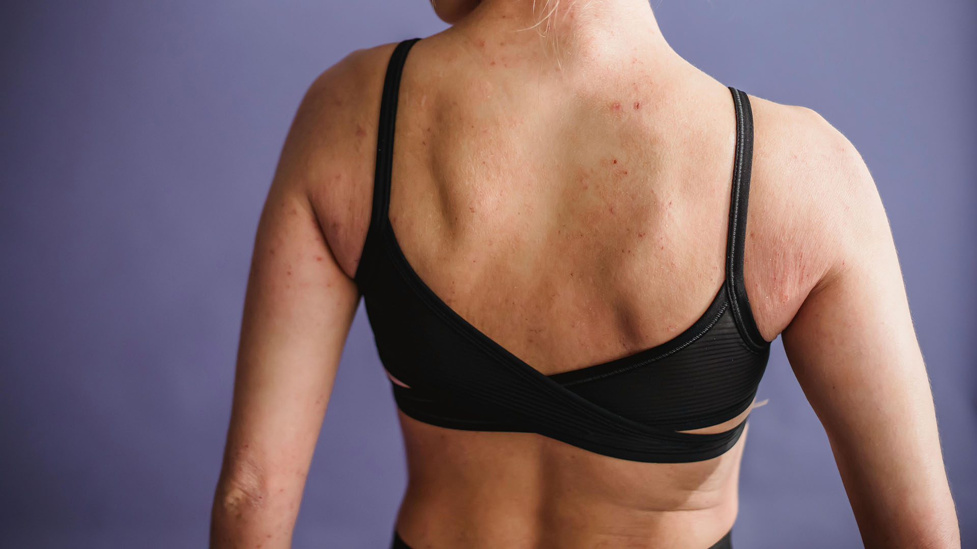 Application Traitement de l'eczéma — Pr. ass. Hüray Hügül