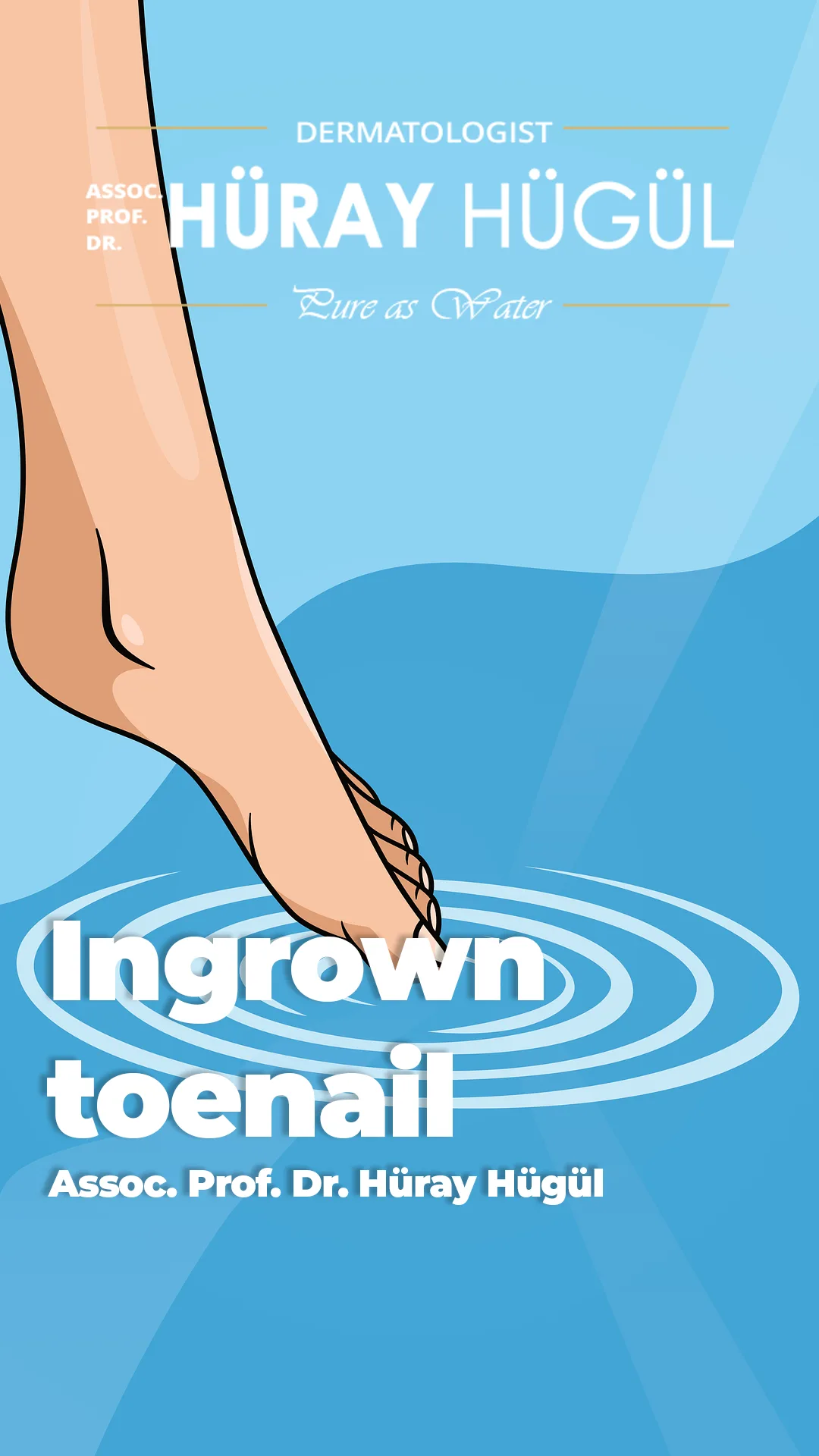 Ongle incarné